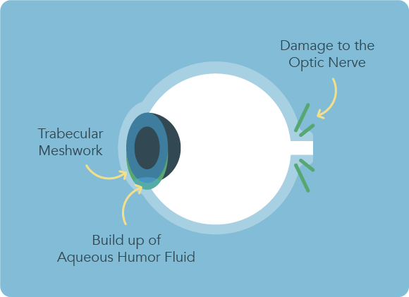 Glaucoma - Intraocular pressure